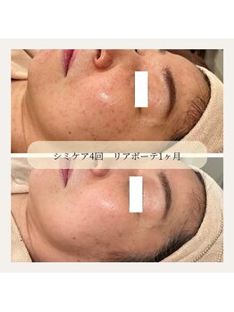 ニコ ウィズ(Nico with)/シミケアプレミアム