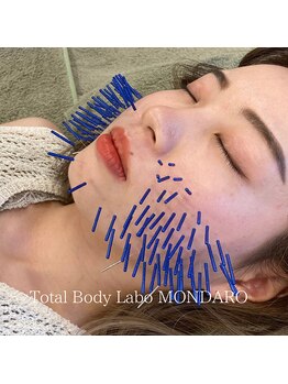 モンダロ(MONDARO)/美容鍼
