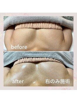 セレーネ(Selene)/片側施術！