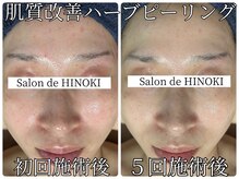 サロン ド ヒノキ(Salon de HINOKI)/肌質改善ハーブピーリング