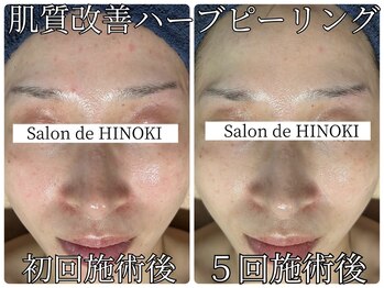 サロン ド ヒノキ(Salon de HINOKI)/肌質改善ハーブピーリング