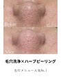ベクラ 名古屋店(Becla)&nbsp;毛穴洗浄 ハーブ