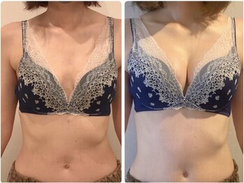 デミーナ(Demyna)/【バストアップ】症例 育乳