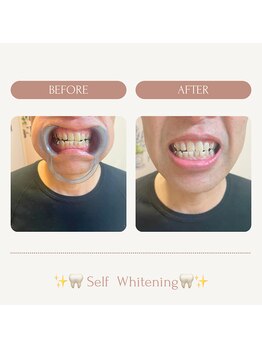 サロンエピ(Salon Epi)/セルフホワイトニング/烏丸御池