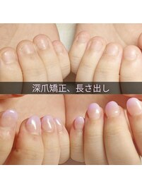 深爪矯正ネイルで生まれ変わる