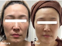 エステ１ヶ月全メニュー通い放題！！