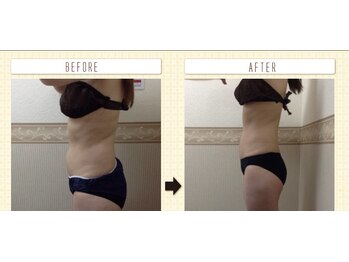 エステティックサロン ピュール ボーテ 東金店/ハイパーナイフ