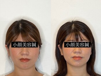 コガオ レンネ(Lenne)/最低4回の施術をおすすめ！