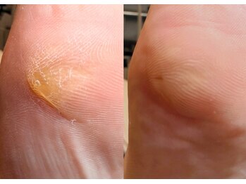 ロッタ(Lotta)/ foot.