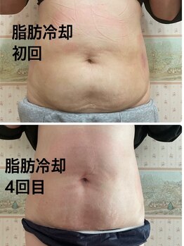 ルフレ/脂肪冷却で理想のボディへ☆