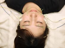 アキュレ(Acure)/★美容鍼ヘッド・デコルテ★