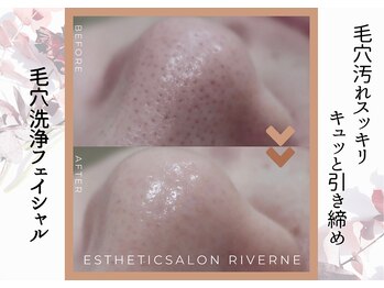 リヴェーヌ 富山店の写真/【様々な毛穴悩みに対応☆小鼻もつるんつるん】開いた毛穴をお掃除＆キュッと引き締める！
