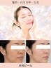 【毛穴・ざらつき・くすみ】むきたまご水光肌◆角質オフ発光素肌｜水光ピール