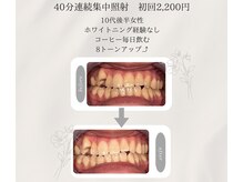 プラスビーセルフ(+b self)/ホワイトニングビフォーアフター
