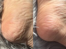 爪のいろは/足裏角質ケア!ガサガサ→つるん!