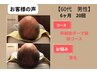 美髪4回コース！幹細胞ダーマ鍼　１回あたり23000円→21500円 どなたでもOK！