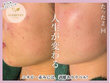 アッシュ 梅田(H)/ハーブピーリング専門Hアッシュ