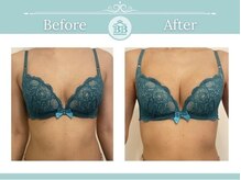 美人バスト 岡山店/バストアップ・バストケア症例★