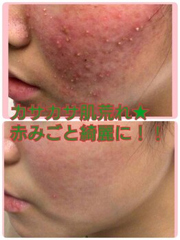 キッカ 梅田天六(Kikka)/かさつくのになぜニキビ?