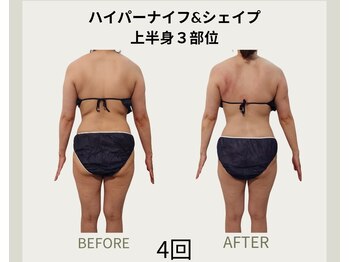 コリ チル(Kori Chill)/【ハイパーナイフ＆シェイプ】