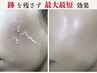 【剥離あり】ミネラルハーブピーリング棘99%×光フォト艶美肌