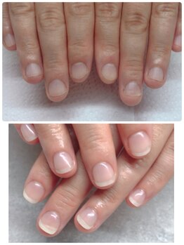 スマイルニコ(smile nico)/深爪矯正【長さ出し有】自爪風