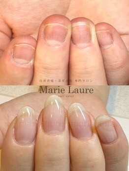 マリーロール 淀屋橋本店(Marie Laure)/自爪育成/深爪矯正/ネイルケア
