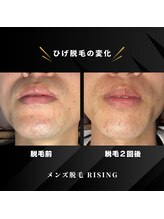 ライジング 熊本菊陽光の森店(RISING)/ヒゲ脱毛２回の変化！