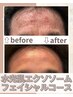 　【美肌ケア】水光肌エクソソームフェイシャルコース