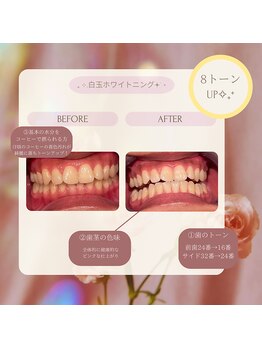 プラスビーセルフ(+b self)/ホワイトニングビフォーアフター