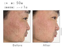 カノン(Kanon.)/リベルハーブピーリング