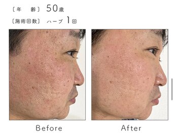 カノン(Kanon.)/リベルハーブピーリング