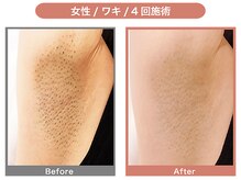 アンフィー 川西能勢口店(Une f`ee)/ワキ脱毛のBefore,After★