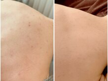 フォア(foi)/背中ハーブピーリング