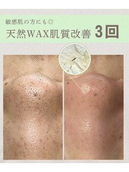 翡翠/小鼻の黒ずみ除去|3回の施術