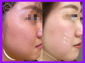ヴィオール 名古屋栄店(VIOR)/【大人気】小顔 光ショット施術