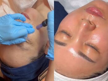 ジュノプラス 諫早店(JUNO+)の写真/【韓国最先端美容で肌質改善】リジュランピール&ララピール導入！リップや乳輪のメラニンケアも大人気！