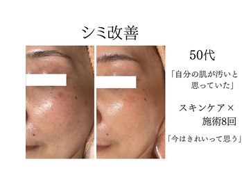 シャルナ(charna)/シミ改善症例