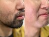 【青ヒゲ卒業】ヒゲワックス+光脱毛(W脱毛)¥7,900【メンズセット】