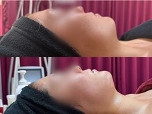 マヤヒメ 大宮店(mayahime)の雰囲気(オンダリフトでスッキリvラインたるみ/法令線/口横ポニョ)