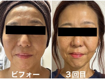 アキュセル ヨウコナース アンド 暢子美容鍼灸(Accu:Cell Youko nurse)/たるみケア　リフトアップ　