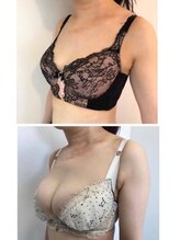 美人バスト 川崎店/バストアップ◇症例◇