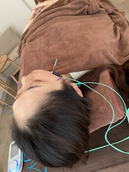 ハリファ鍼灸院 横浜関内院(HariFa鍼灸院)/美容施術/美容鍼
