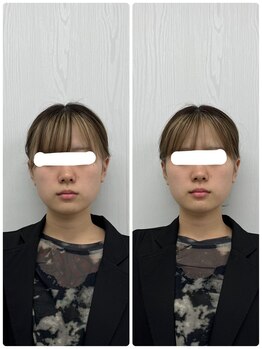 ラフテル鍼灸整骨院/小顔矯正/整体で左右差改善◎