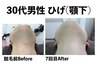 【初回限定】ヒゲ脱毛体験◎痛み少なめ＆都度払いで安心♪2980円！