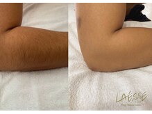 ラエッセ(LAESSE)/<メンズ>ひじ下脱毛