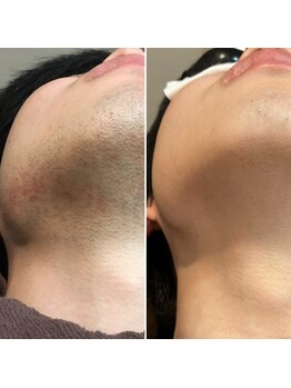 トリプルワン(111)/ひげ脱毛