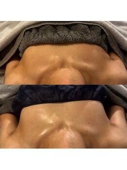 ベリッシマ筋膜セラピー/バストアップにも筋膜リリース