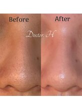 ドクターエイチ 麻布十番店(Doctor.H)/毛穴洗浄×美容液導入で肌質改善