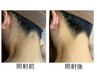 【今年の夏に間に合う!後ろ姿美人】うなじ脱毛¥5500